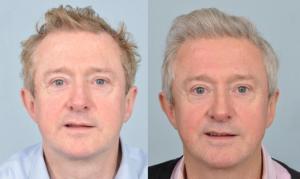 louis-walsh-before-after-testimonial