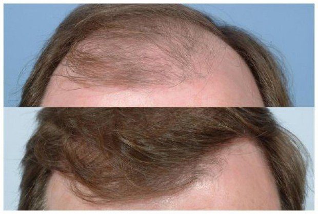 Hair transplant before and after photos Hair transplant before and after photos