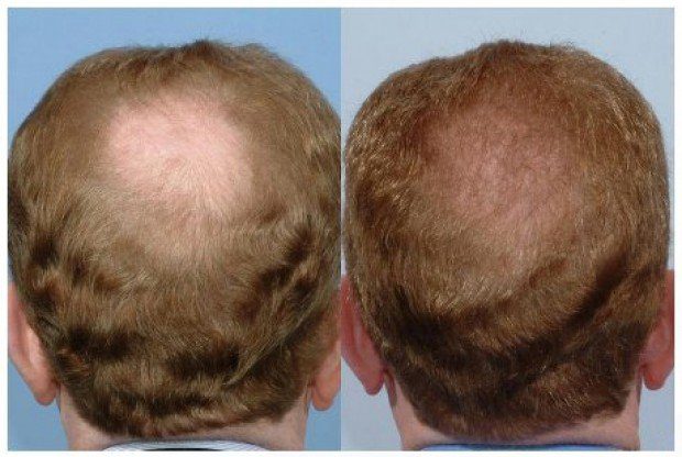 What causes hair loss in men? What causes hair loss in men?
