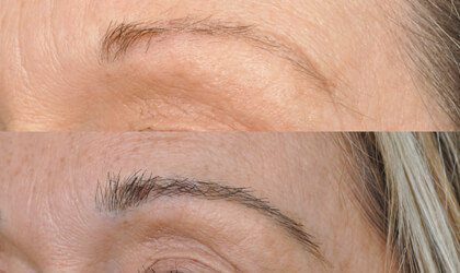 Christine Blundell Eyebrow Hair Transplant-HRBR-before-after