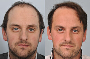 Louis-Ricardo-Blundell-HRBR-before-after