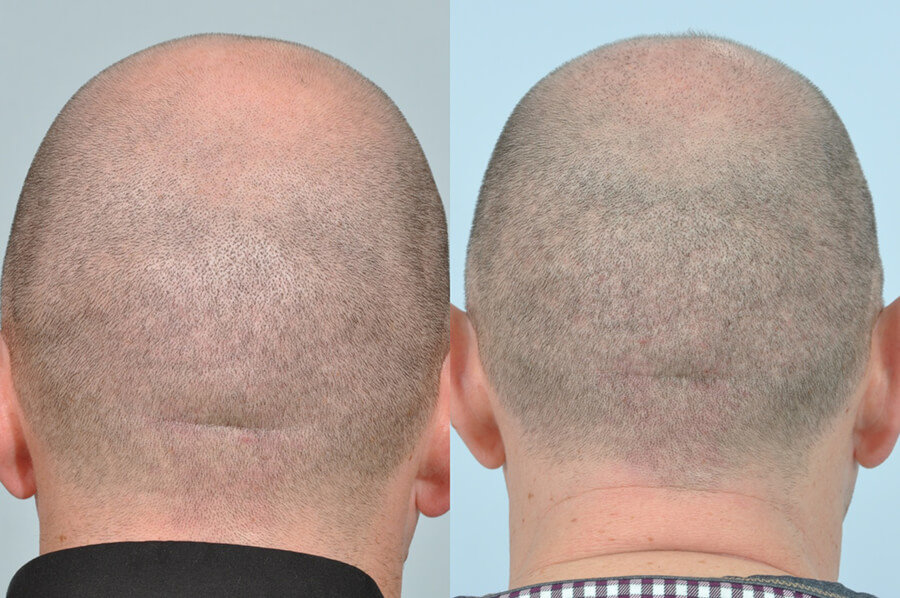 FUE hair transplant before and after