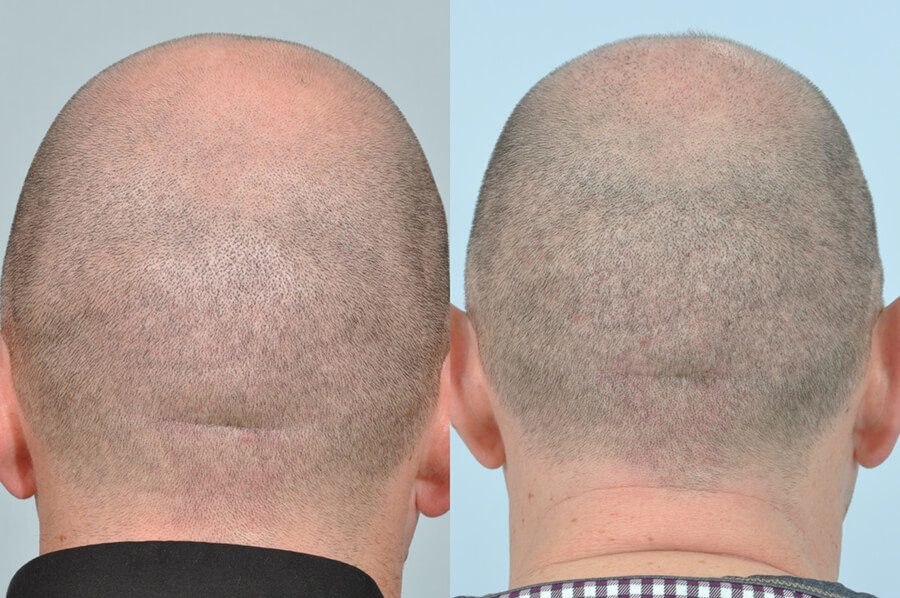 FUE Procedure - Hair Transplant Clinic Ireland FUE Procedure - Hair Transplant Clinic Ireland
