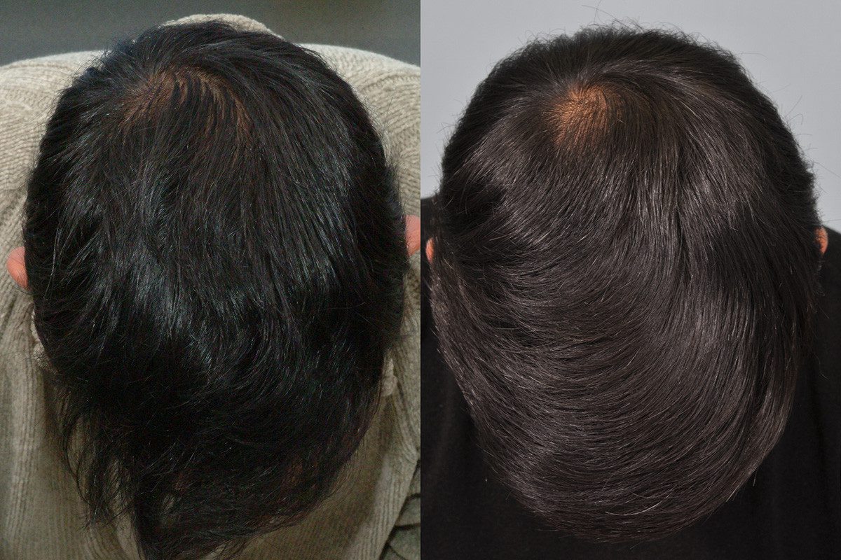 Minoxidil (Regaine) & Finasteride results after 10 years Minoxidil (Regaine) & Finasteride results after 10 years