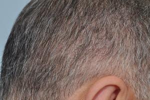 Donor area scar is covered by the patient’s hair