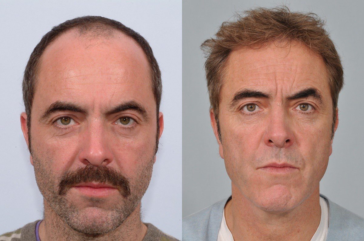 James Nesbitt Hair Transplant at HRBR - Latest Results James Nesbitt Hair Transplant at HRBR - Latest Results