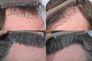 Hair transplant repair - before and after