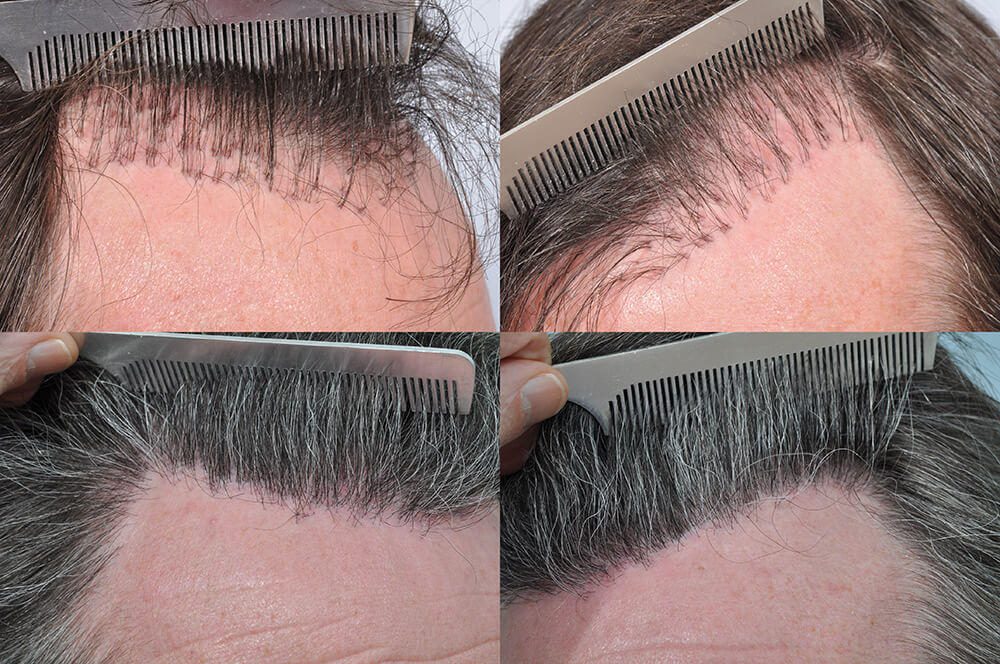 Hair Transplant Repair | Before & After Repair Surgery
