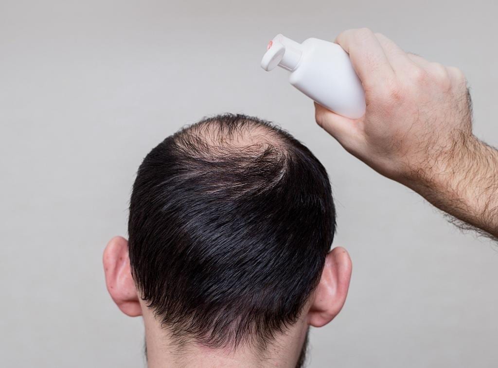 Shampoo for Thinning Hair – Can it Help? Hair Loss Advice