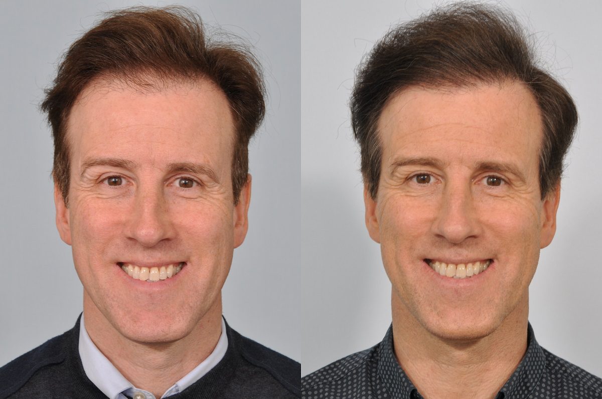 Anton du Beke before and after hair transplant