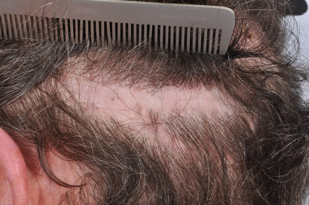 Hair Transplant Repair Case Study | HRBR Blackrock Hair Transplant Repair Case Study | HRBR Blackrock