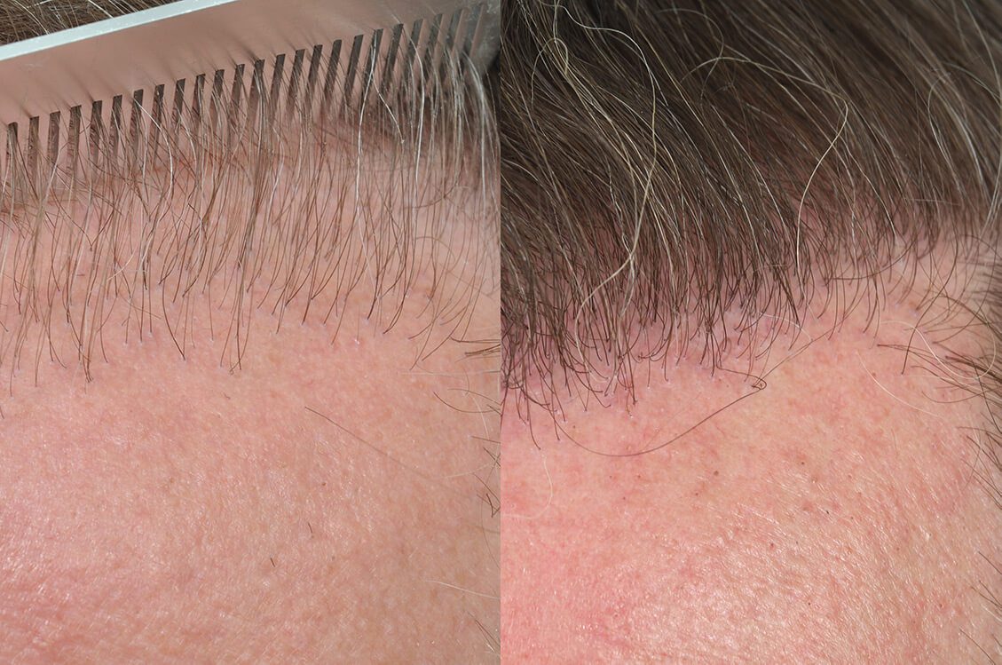 Hair Transplant Repair Work | Hair Restoration Blackrock