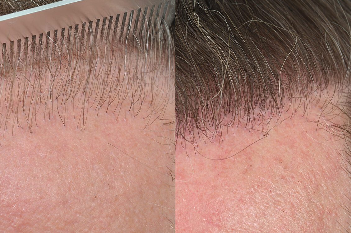 Hair Transplant Repair Work | Hair Restoration Blackrock Hair Transplant Repair Work | Hair Restoration Blackrock