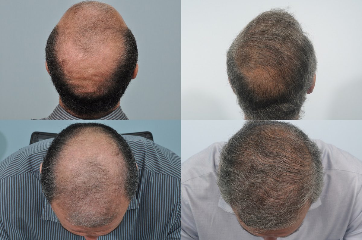 How Long Does a Hair Transplant Last? - Hair Transplant Clinic Ireland How Long Does a Hair Transplant Last? - Hair Transplant Clinic Ireland