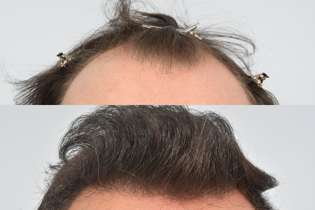 Hair Transplant Clinic Ireland | Hair Restoration Blackrock