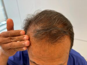 male pattern baldness and risk of skin cancer