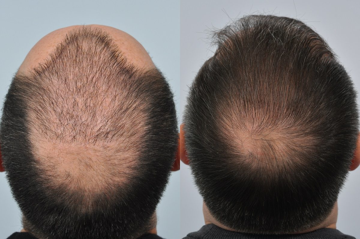 Hair Transplant Repair Work | Hair Restoration Blackrock Hair Transplant Repair Work | Hair Restoration Blackrock