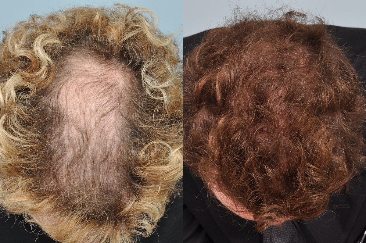 hair transplant curly hair - before & after